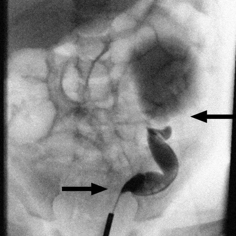 Contrast-enhanced imaging reveals fluid buildup and bilateral ureteral obstruction in the kidneys.