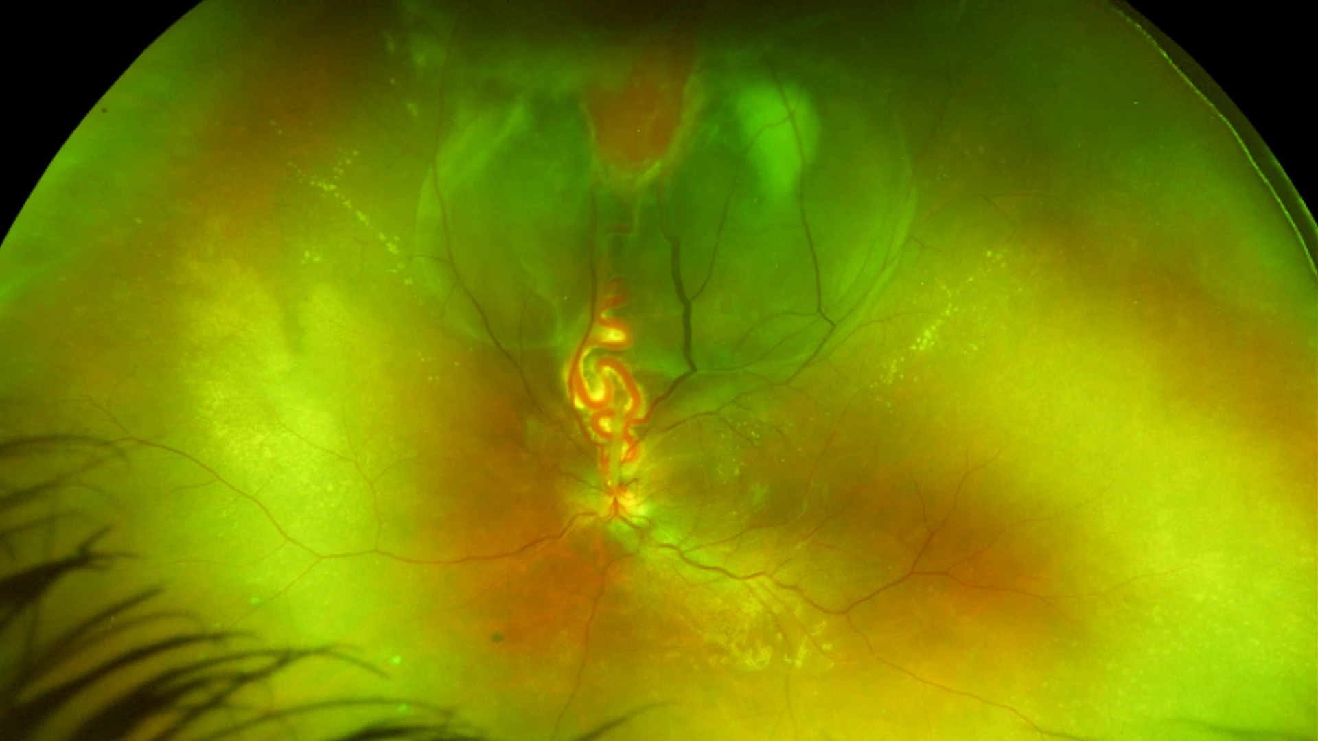 Fundus image of the tumor with a retinal detachment and the dilated feeder blood vessels 