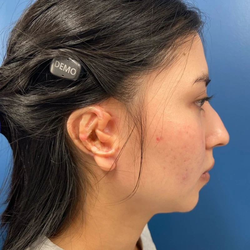 The patient is seen eight months after her stage 1 reconstruction and is ready for stage 2 to lift forward the framework.