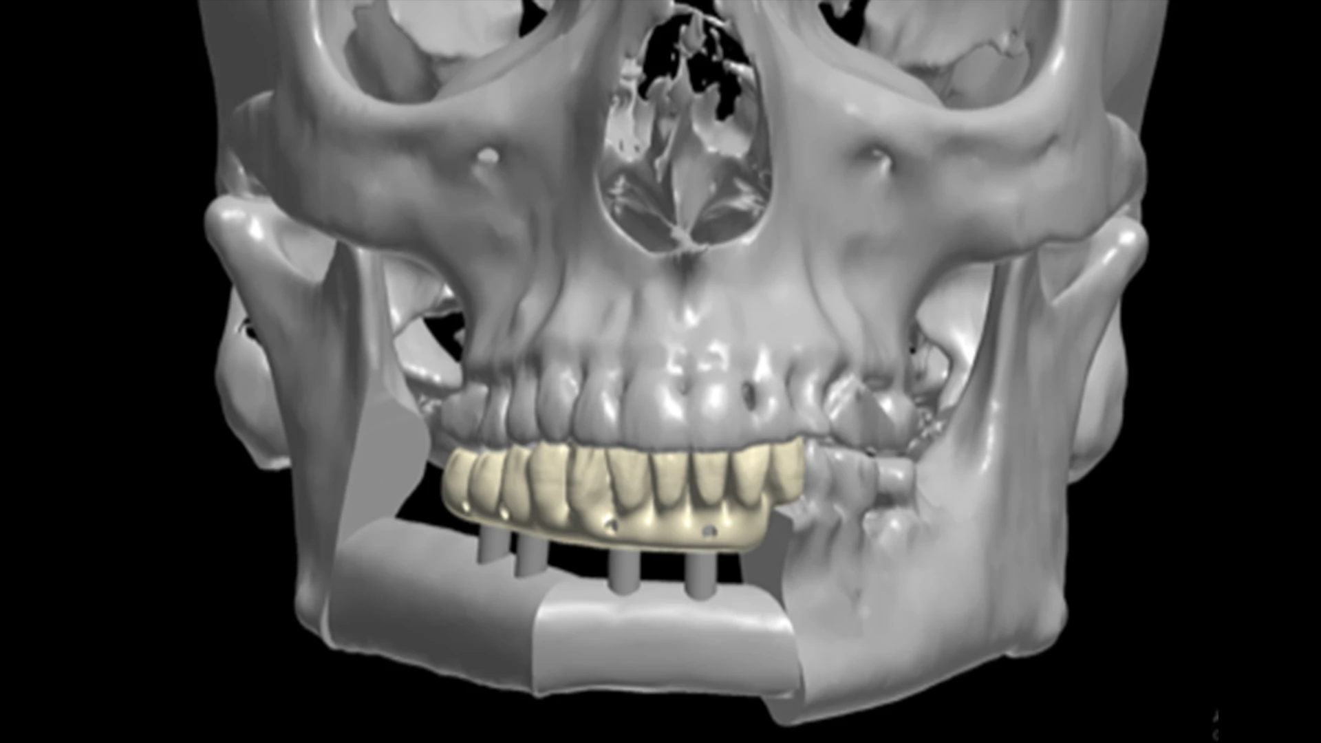 The plan for the teeth to be created prior to the surgery.