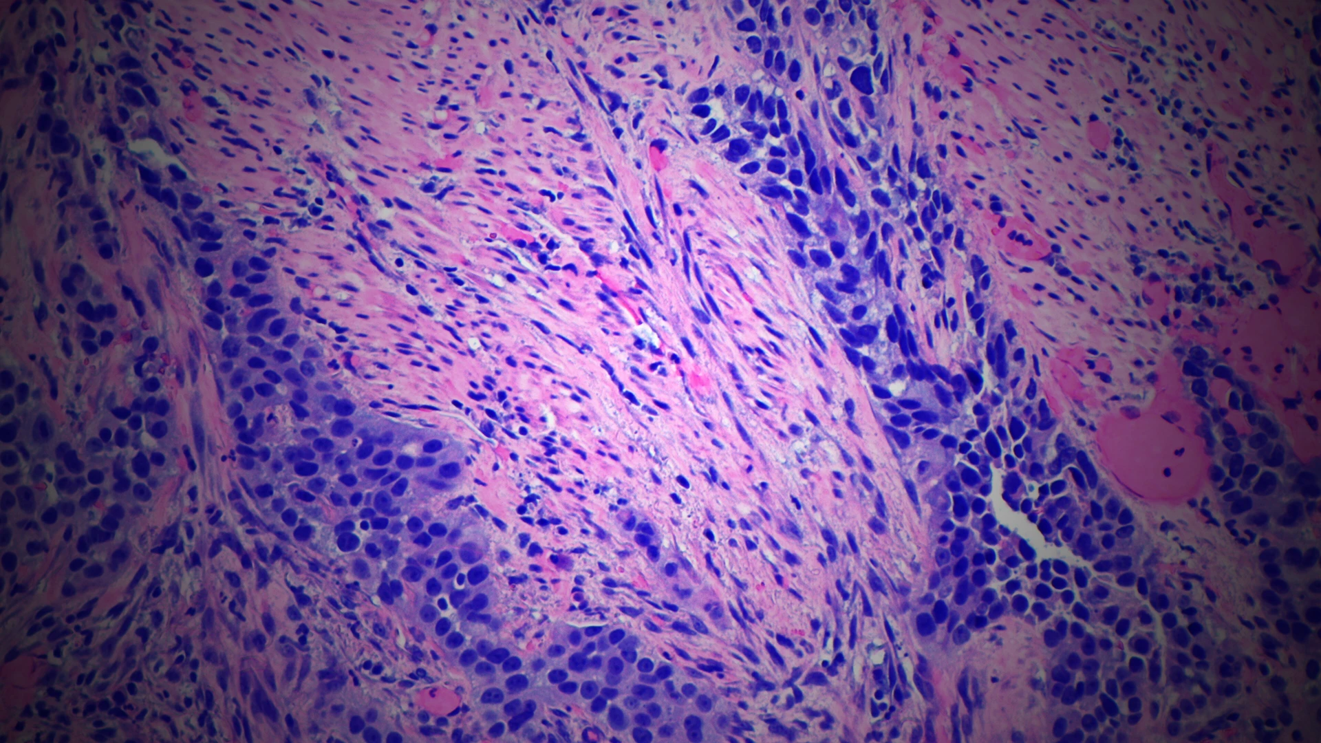 Bespoke Blood Tests Identify Bladder Cancer Patients With High Risk of Recurrence