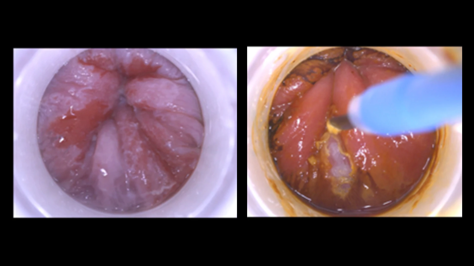 Early anal lesions (precancerous without deep invasion) are identified and treated by burning them off in the office.