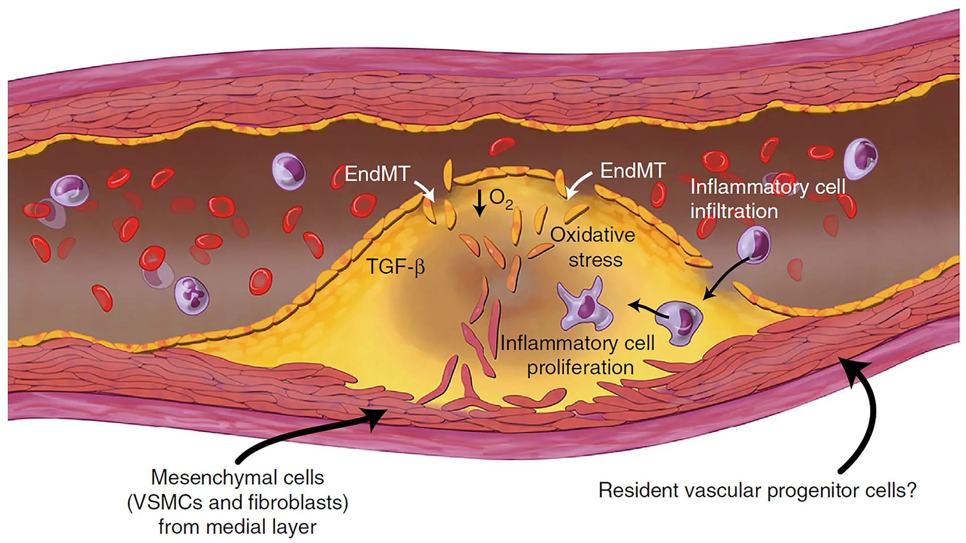 A schematic illustration of the cellular contributions to atherosclerotic plaques, where EndMT (endothelial to mesenchymal transition) plays a key role. (From a related 2016 paper, "Endothelial to mesenchymal transition is common in atherosclerotic lesions and is associated with plaque instability" in Nature Communications.)
