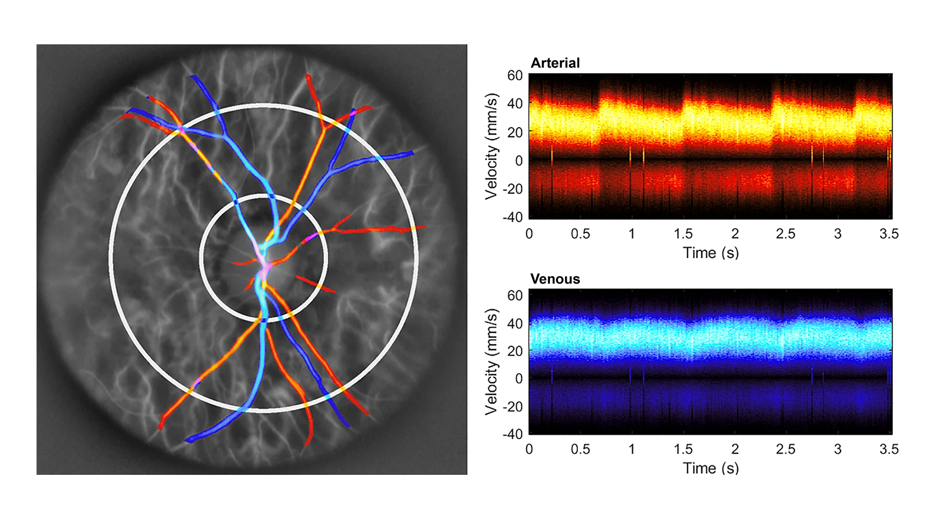 Healthy control, with normal intraocular pressure