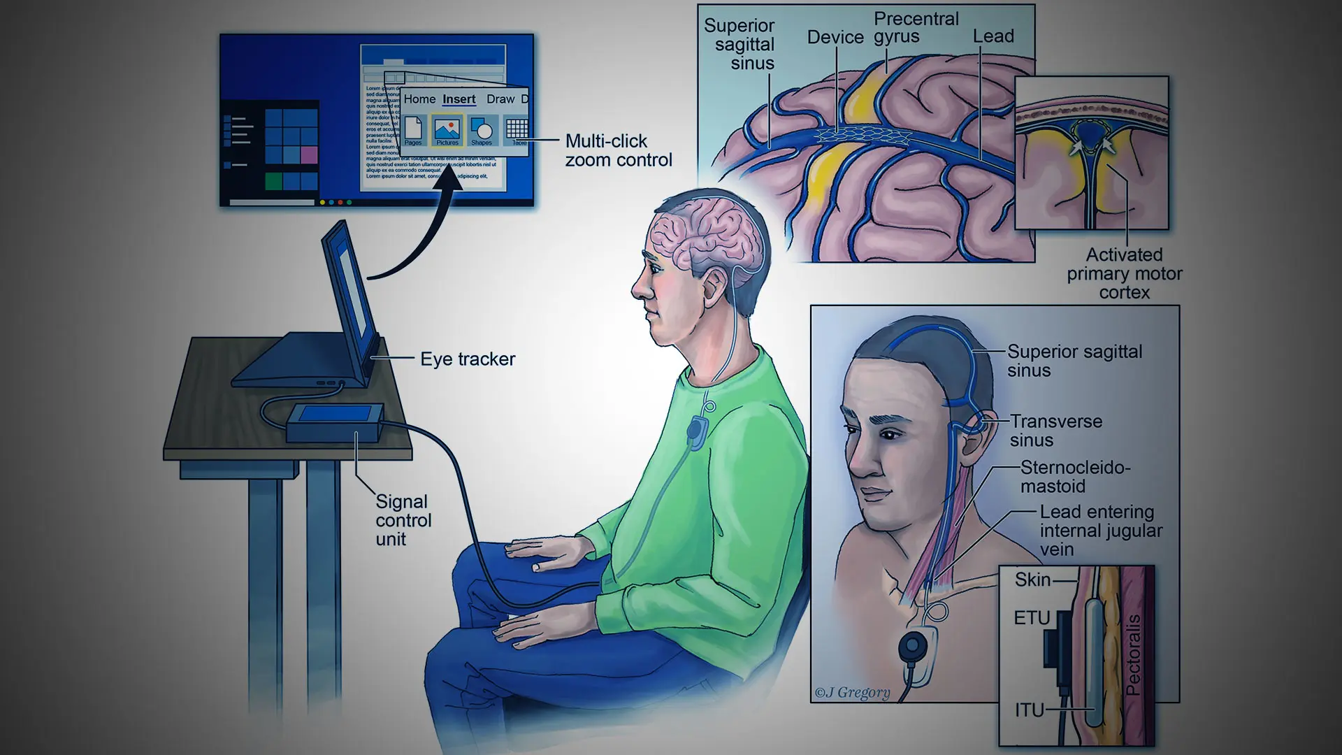 Neurosurgery at the crossroads of immunology and nanotechnology. New  reality in the COVID-19 pandemic - ScienceDirect