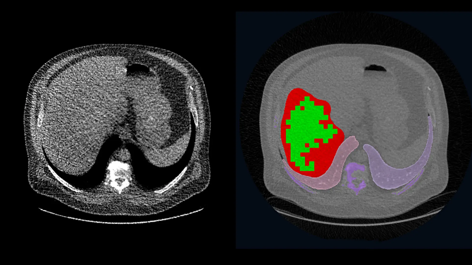 Left: A single slice of the CT scan for a participant in the WTC study with a liver density indicative of moderate-to-severe steatosis. Right: The same CT scan shows the region of the liver to be analyzed in red, the sampled areas in green, and other organs in purple (the lungs and vertebrae).  





 





