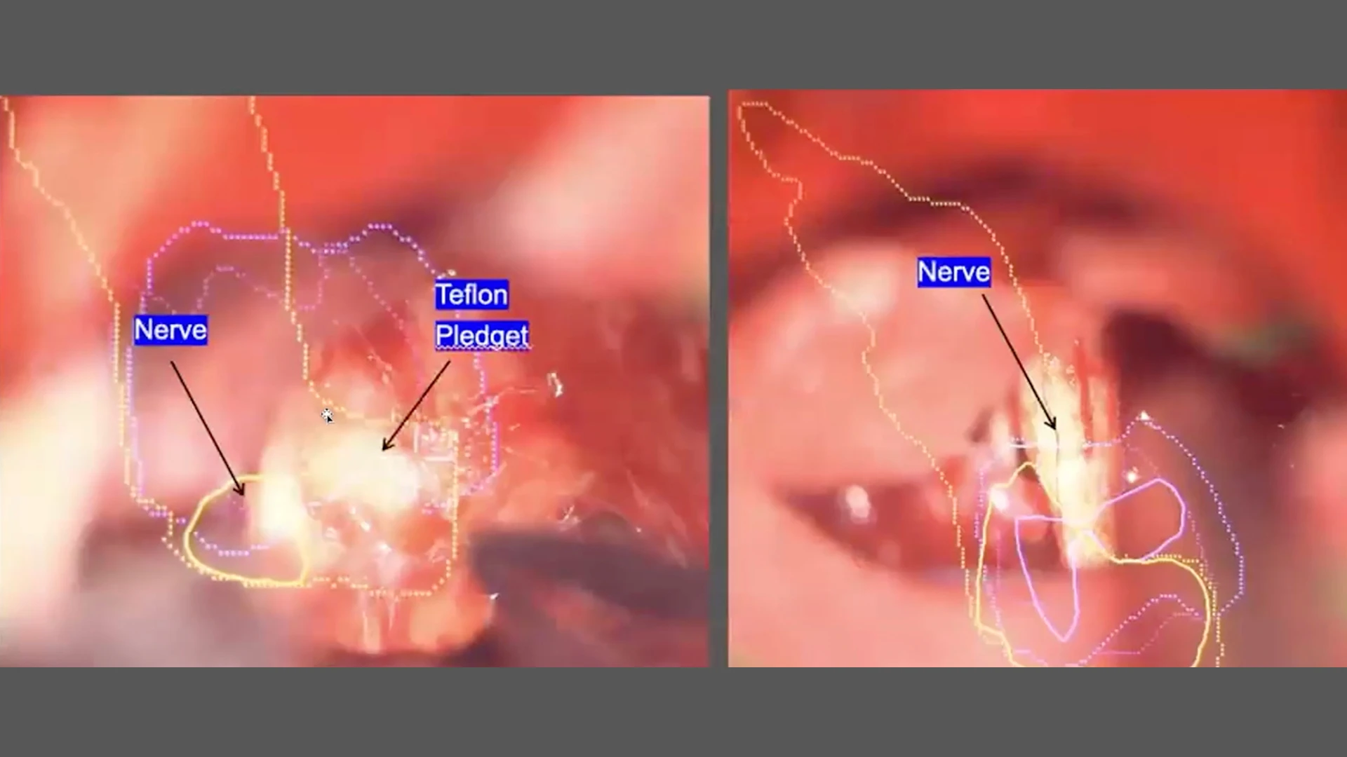 Surgical intervention for trigeminal neuralgia can provide durable, long-term relief in appropriately selected multiple sclerosis patients.