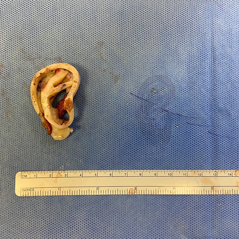 Using the template as a guide, the cartilages are carved into the three-dimensional shape of an ear.