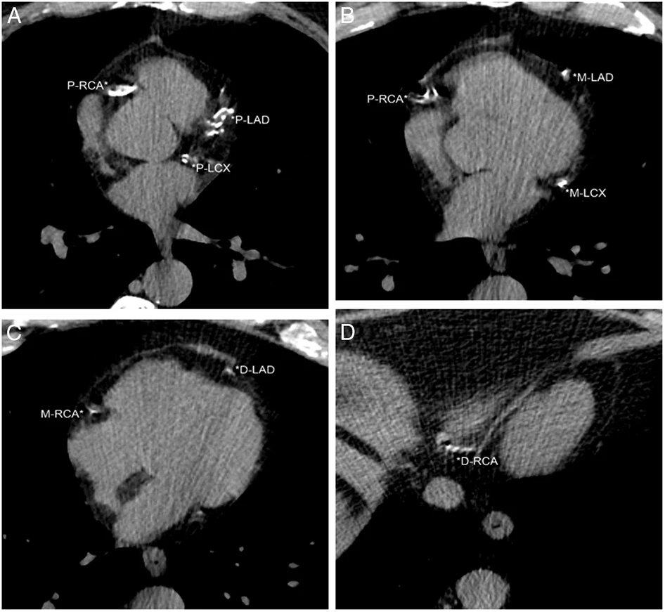 The heart is fully visualized on LDCT screenings for lung cancer, making it suitable for cardiovascular assessments. Dr. Henschke's team developed a visual assessment of coronary artery calcifications (CACs) for LDCT scans that provided a 12-point score by assessing each of the four coronary arteries. In this figure, the patient had an ordinal CAC score of 8 based on calcifications in the proximal left anterior descending (P-LAD), proximal left circumflex (P-LCX), and proximal right coronary arteries (P-RCA) on A, mid left anterior descending (M-LAD) and mid left circumflex (M-LCX) coronary arteries on B, distal left anterior descending (D-LAD) and mid right coronary arteries (M-RCA) on C, and distal right coronary artery (*D-RCA) on D. 