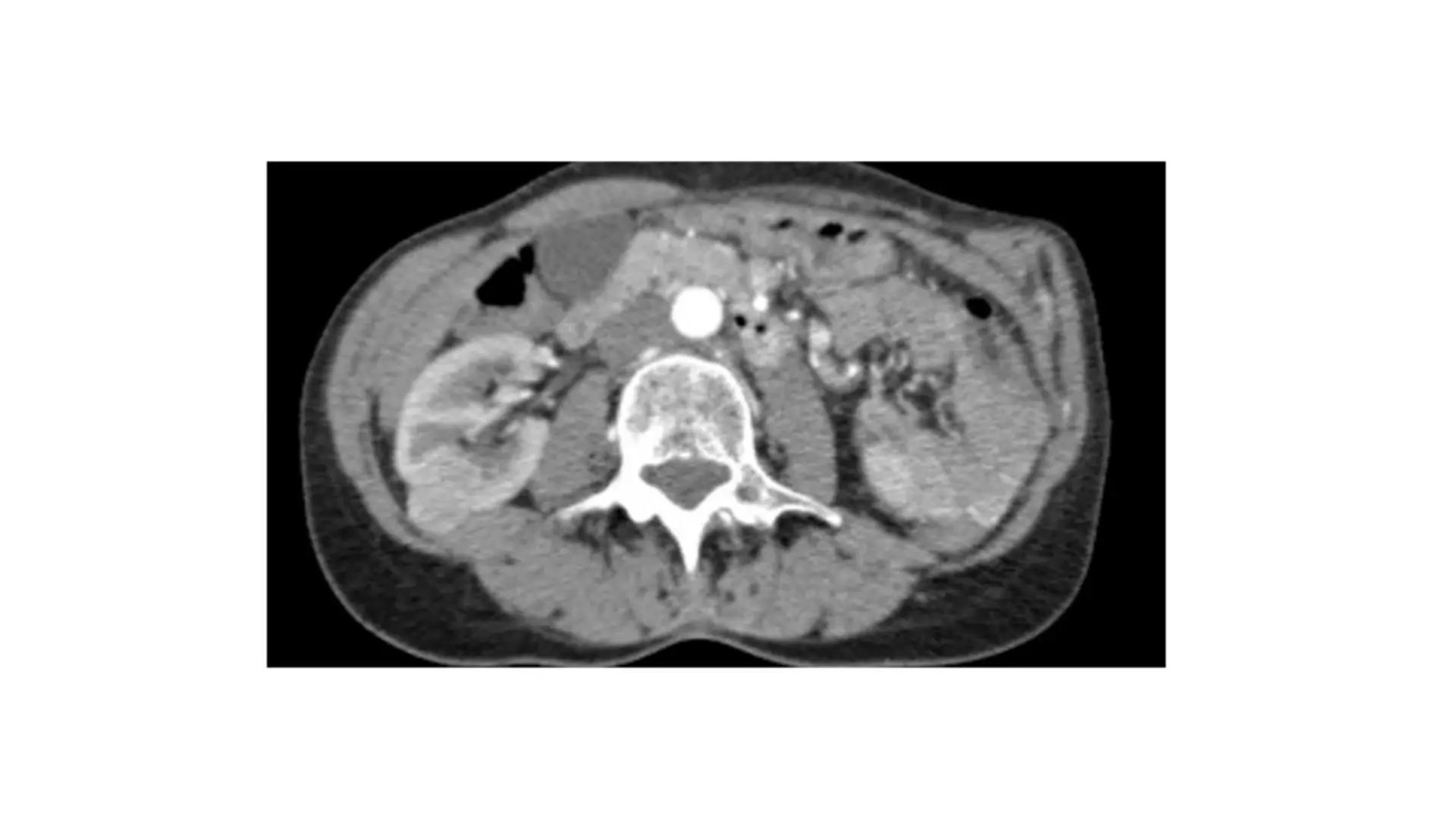A posterior tumor that is ideal for the retroperitoneal approach

