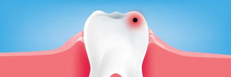 What are Dental Caries? Treatments, Signs, and Symptoms article banner