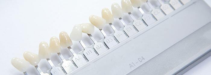 Dental Veneers - What to Expect