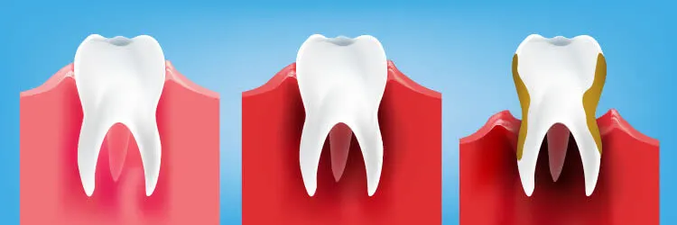Types of Gum Disease: Stages, Factors & Related Conditions article banner