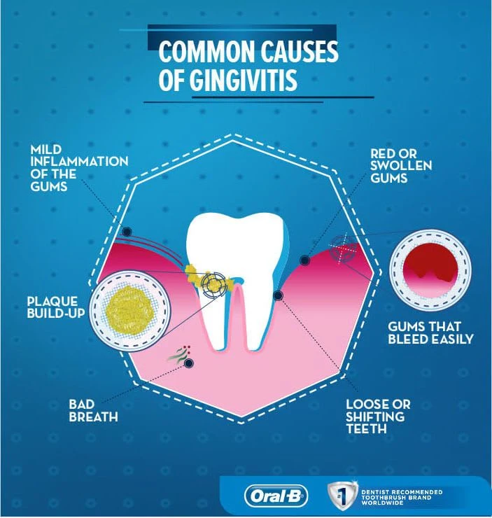 What is Gingivitis? Symptoms, Causes, and Treatments