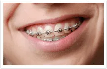 Metal braces/Traditional braces 