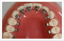 Lingual Braces 