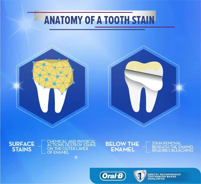 Article Teeth Stains: Causes Removal and Whiter Teeth - Image 1