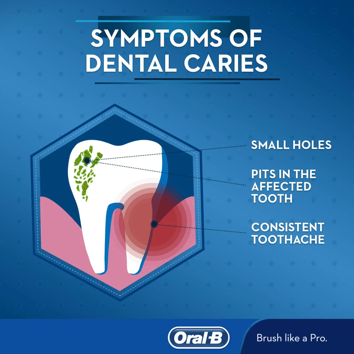 Article What are Dental Caries? Treatments, Signs, and Symptoms - Image 1