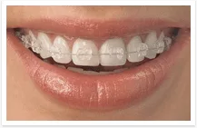 Ceramic Braces 