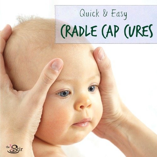 natural ways to treat cradle cap
