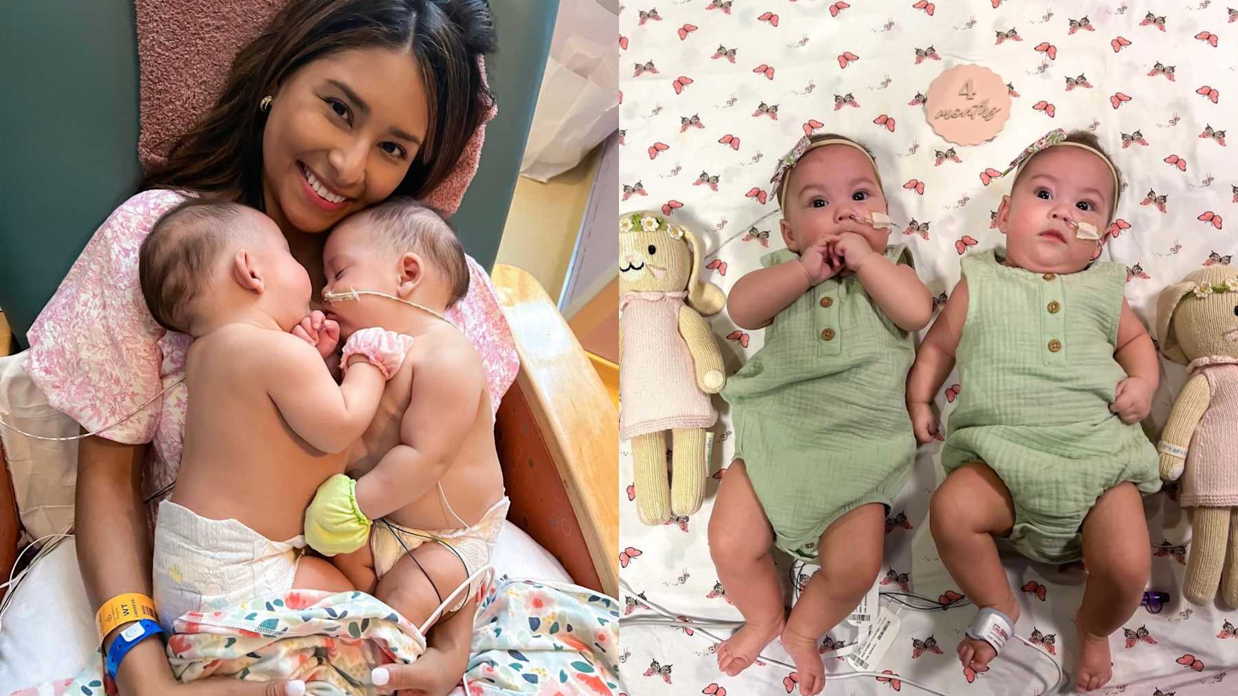 3 Conjoined Formerly Conjoined Twins Home From Hospital After Successful Separation ...