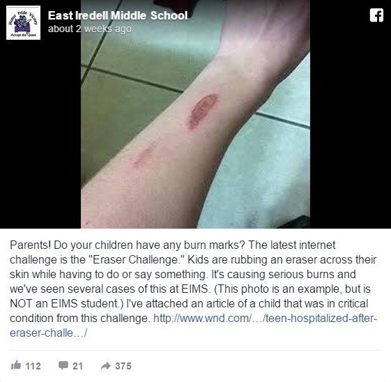 Kids Severely Injured Trying 'Eraser Challenge'
