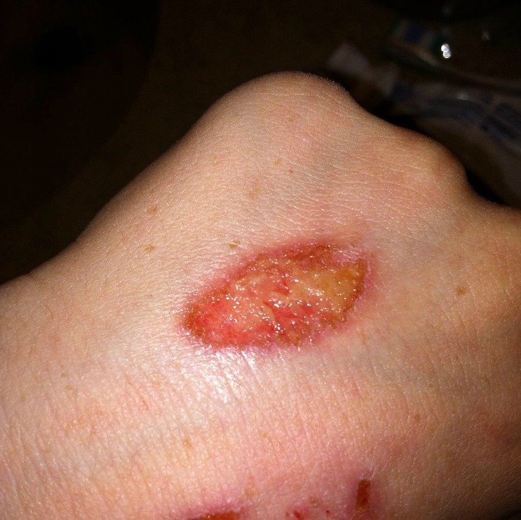 Kids Severely Injured Trying 'Eraser Challenge'