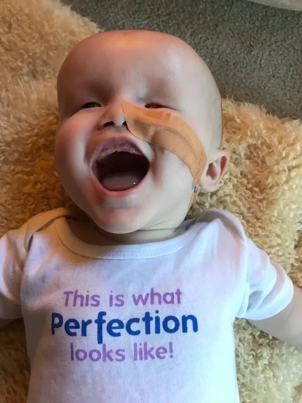 Baby born without eyes