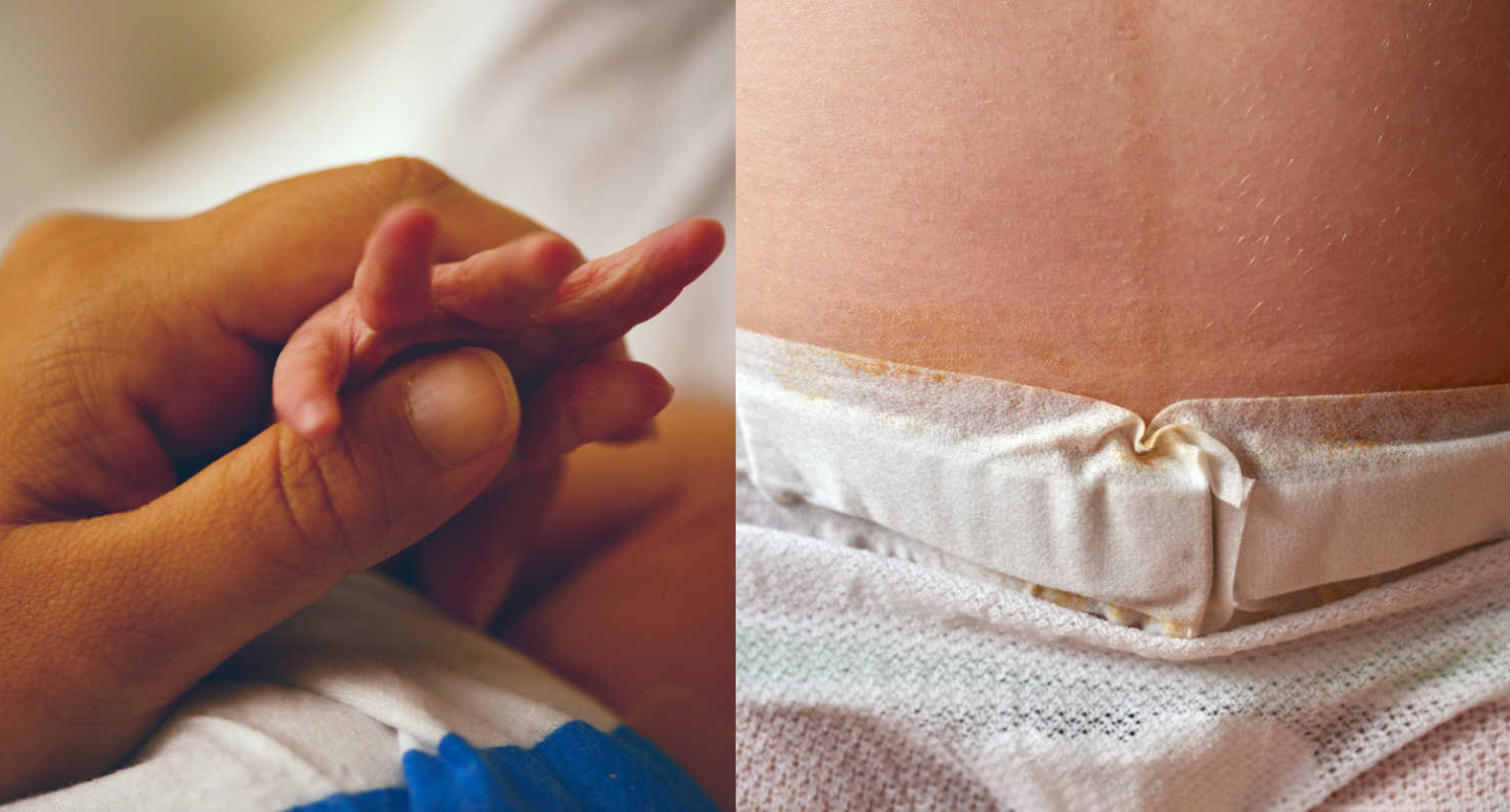 Mom's Photo Proves C-Section Is Not the Easy Way Out | CafeMom.com