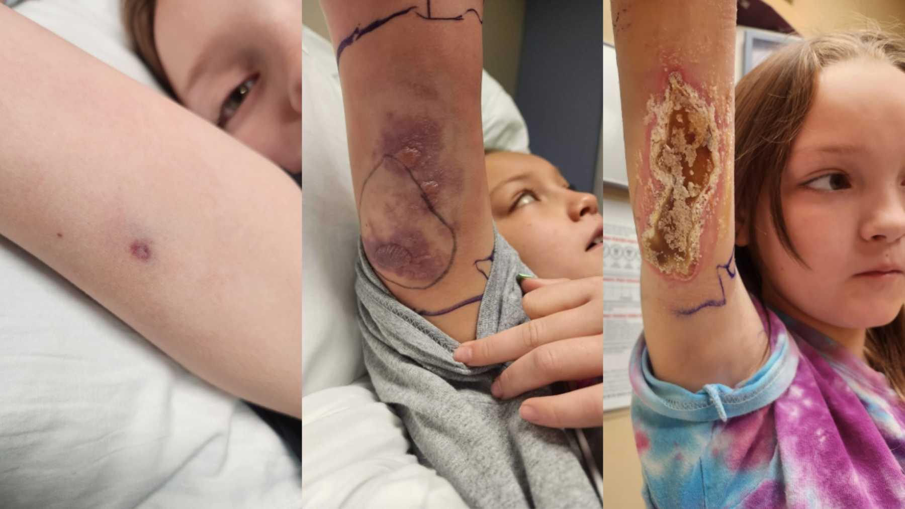 Girl, 9, Thinks Tag Pinched Her, Mom Discovers Brown Recluse Spider Bite  (Exclusive)