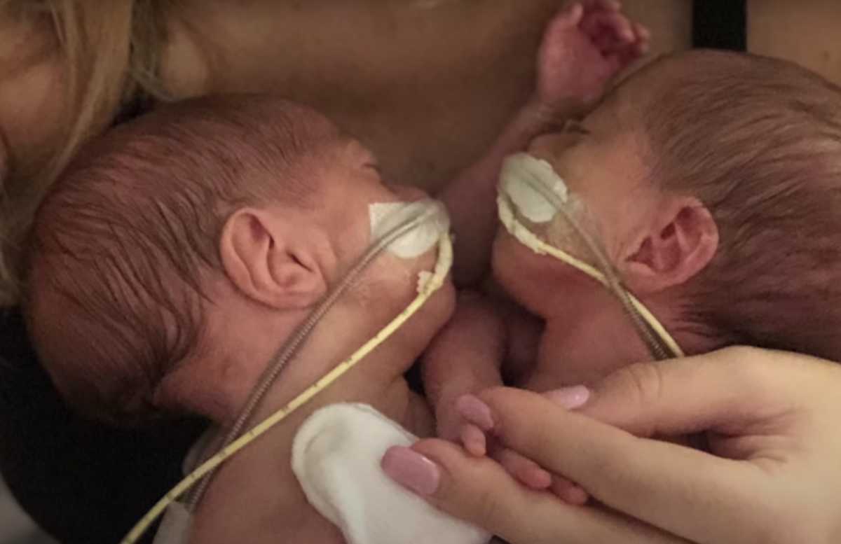 How are the Altobelli conjoined twins doing today? All the details 