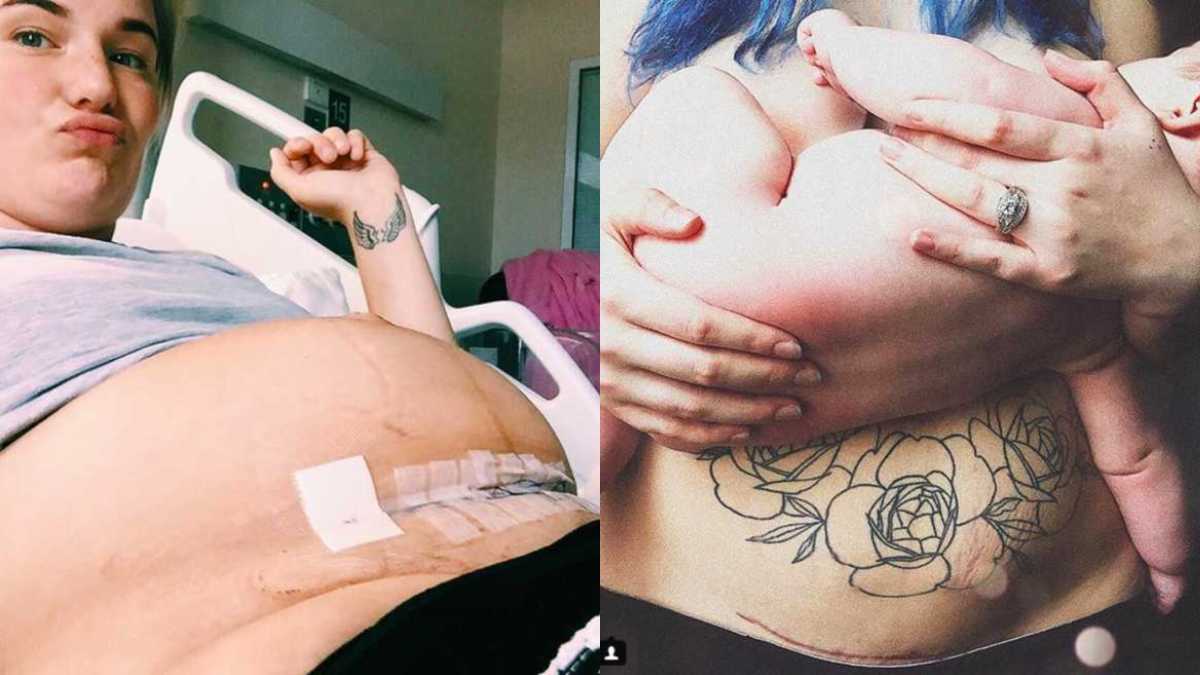 Raw Photos That Show the Reality of C-Section Scars