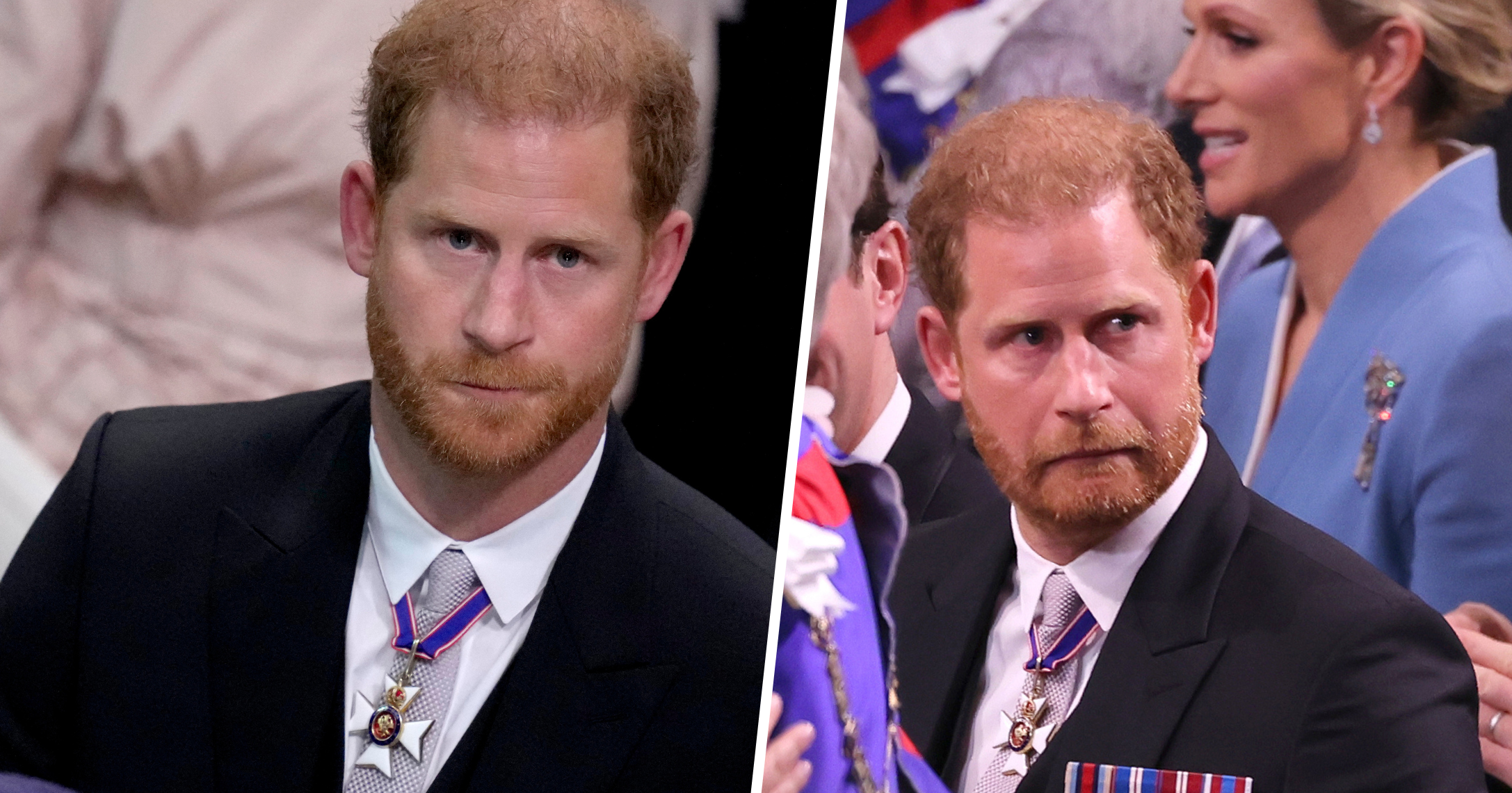 Experts Say Prince Harry&rsquo;s Balding Is Only Getting Worse With Stress