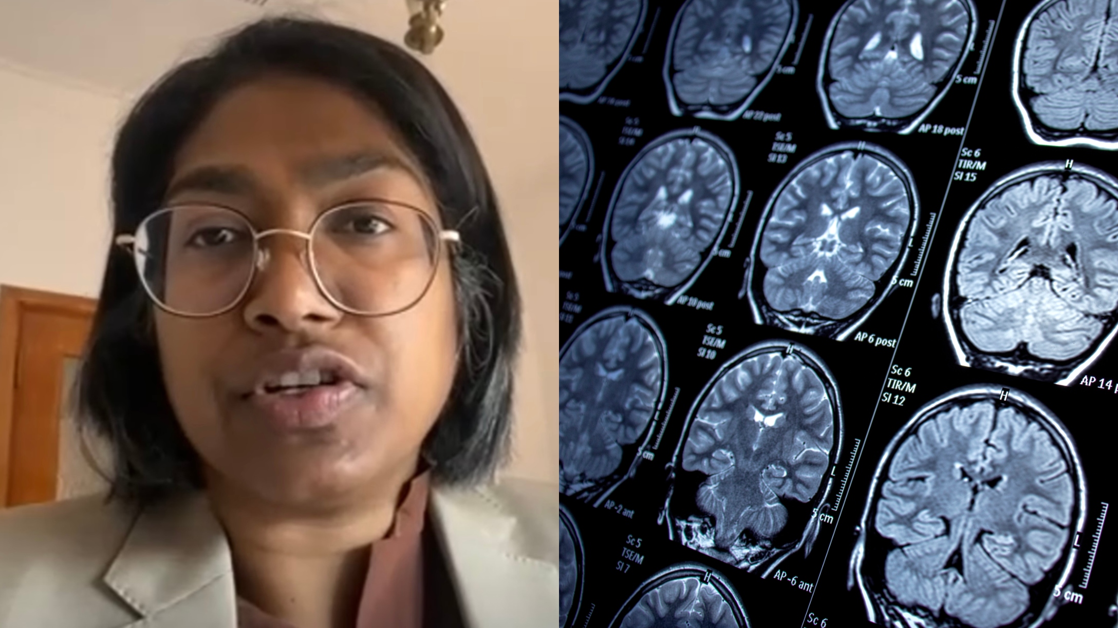 Woman Has Live 3Inch Worm In Her Brain — 'She Was an Accidental Host