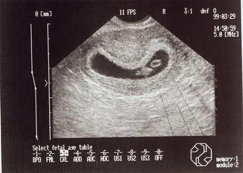 ultrasound of baby