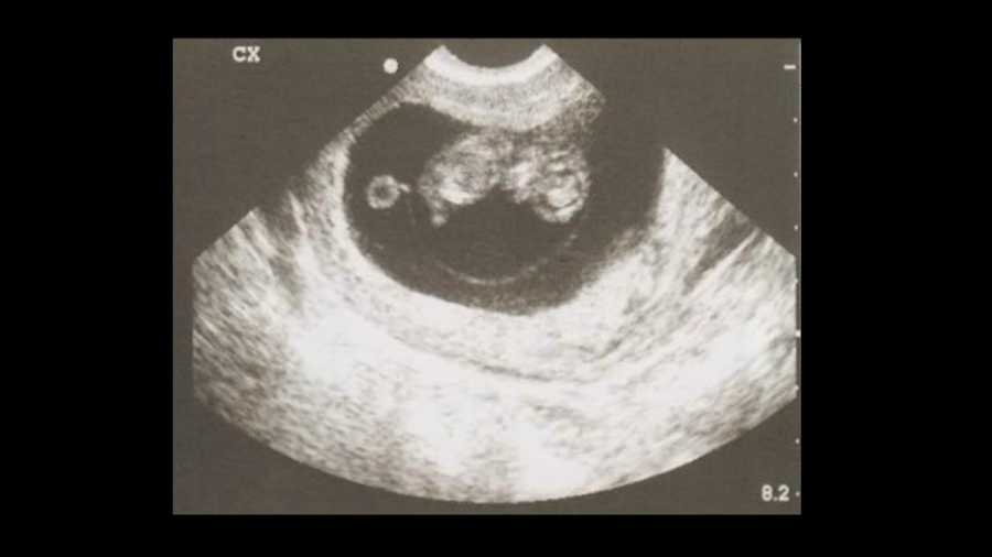ultrasound baby gender.