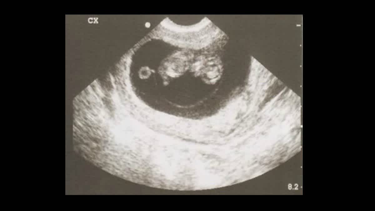 Detect gender when can ultrasound Can an