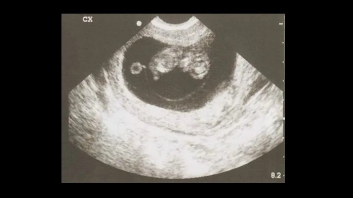 ultrasound baby gender