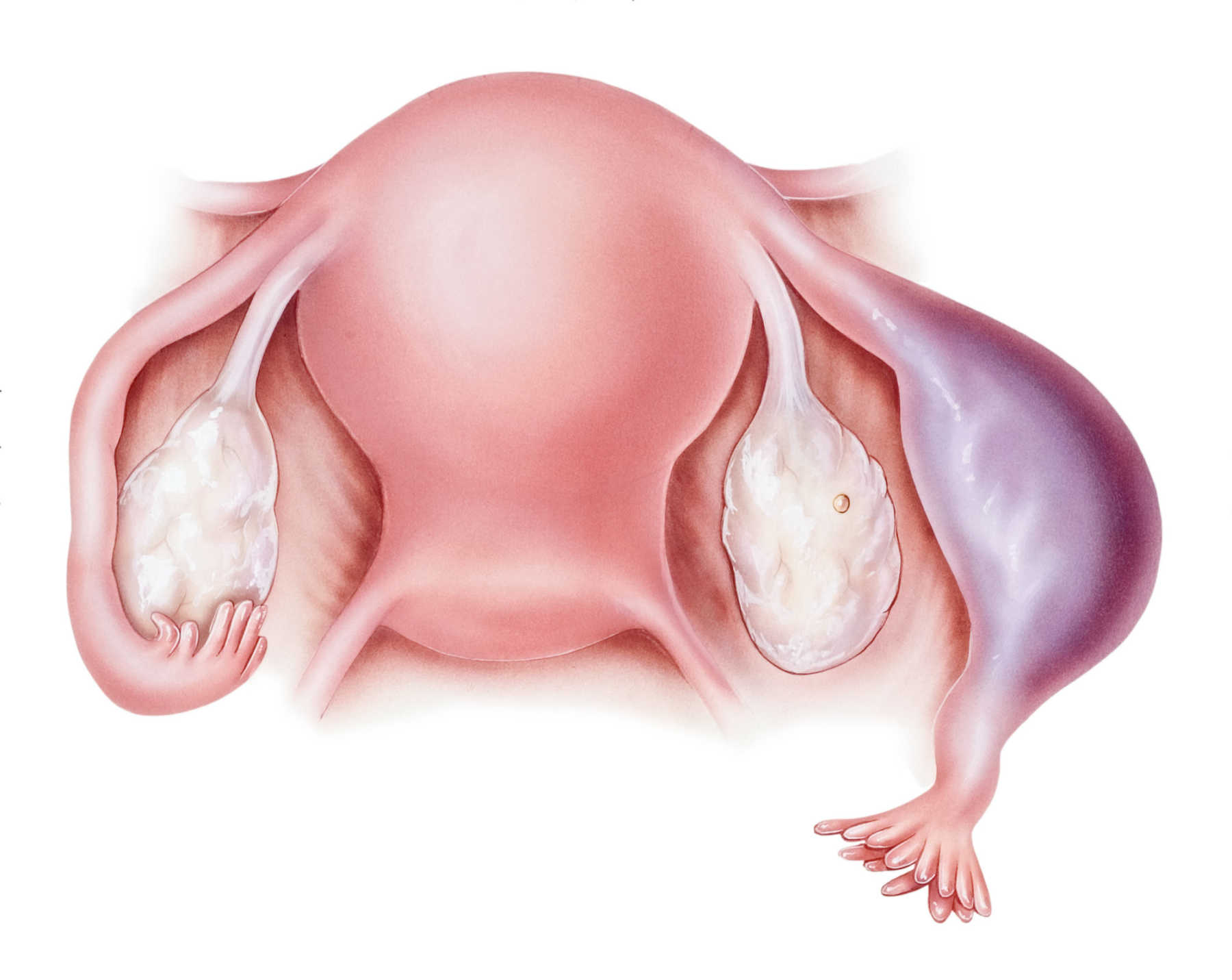 Болит яичник во время беременности. Внематочная беременность.