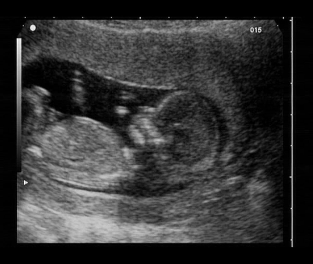6 Ways to Tell Babys Gender From an Early Sonogram CafeMom photo