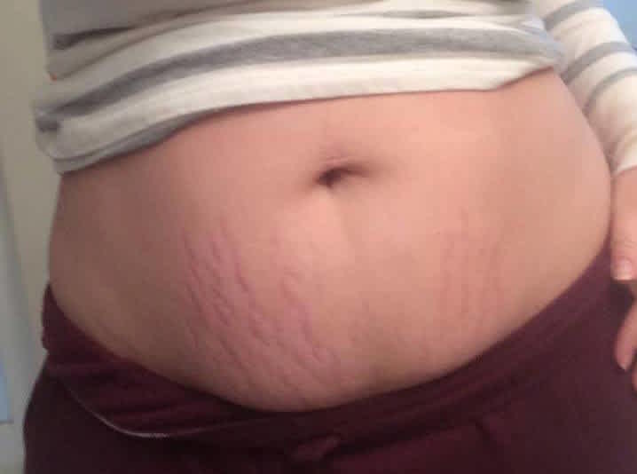 The truth about stretch marks