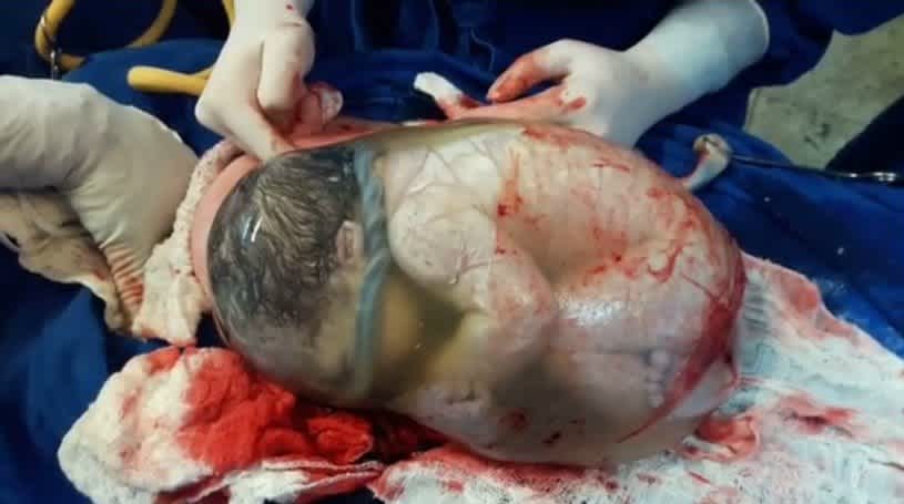 Breathtaking Video Captures a Baby Being Born Inside Amniotic Sac | CafeMom.com Breathtaking Video Captures a Baby Being Born Inside Amniotic Sac | CafeMom.com