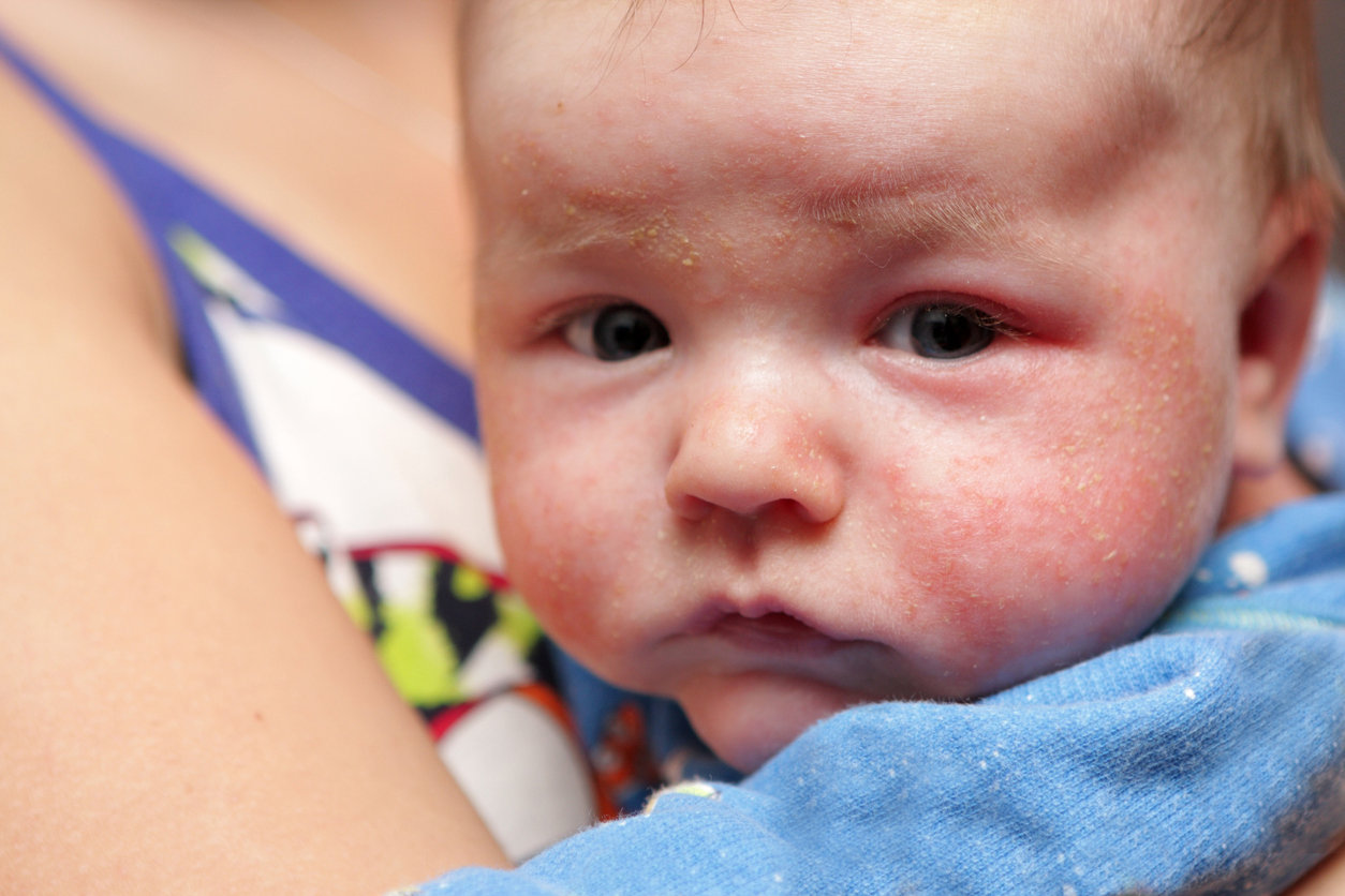 When Does Eczema Start in Babies?