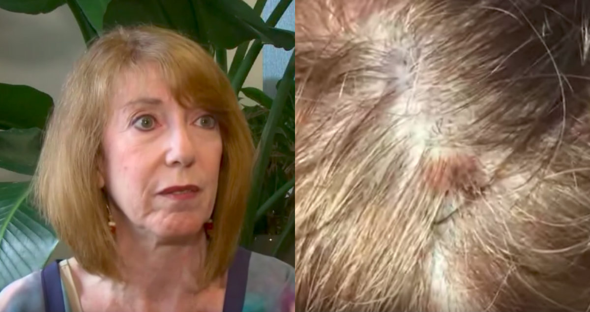 woman-s-hairstylist-noticed-a-deadly-mole-on-client-s-scalp-cafemom