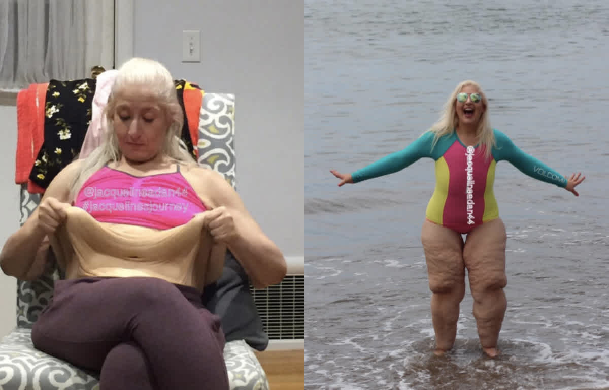 This Woman Refuses to be Ashamed of Her Loose Skin