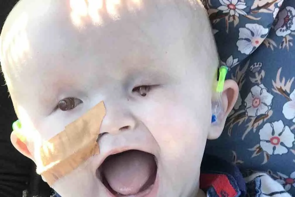 Baby born without eyes