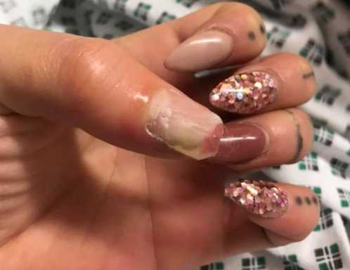 How Acrylic Nails From The Salon Almost Made This Woman Lose Her Thumb Cafemom Com
