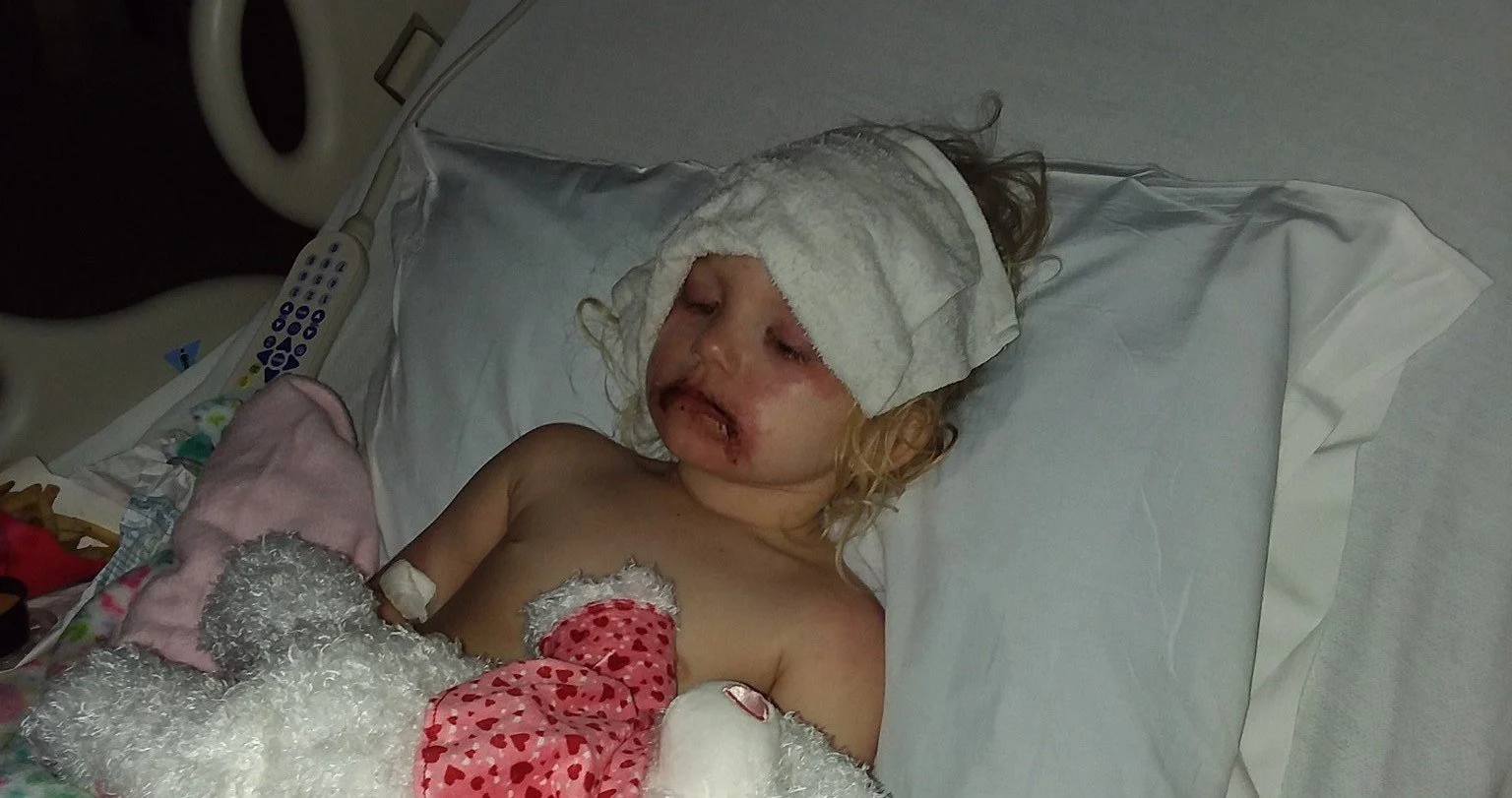 toddler severely blistered by kids makeup kit