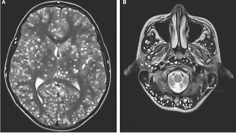 tapeworm in brain