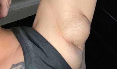 Armpit bulge and your Tail of Spence - Should it be in my Bra? –